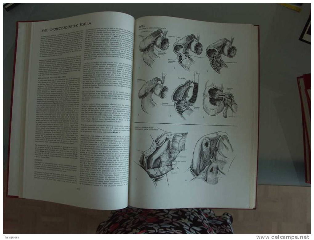 ATLAS OF BILIARY TRACT SURGERY By Frank Glenn - The Macmillan Company New York - Chirurgie