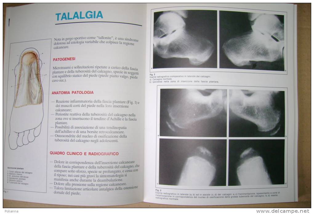 PEG/44 Caruso-Mancini-Puddu PATOLOGIA DELLO SPORT Angelini 1980/ORTOPEDIA - Medicina, Psicologia