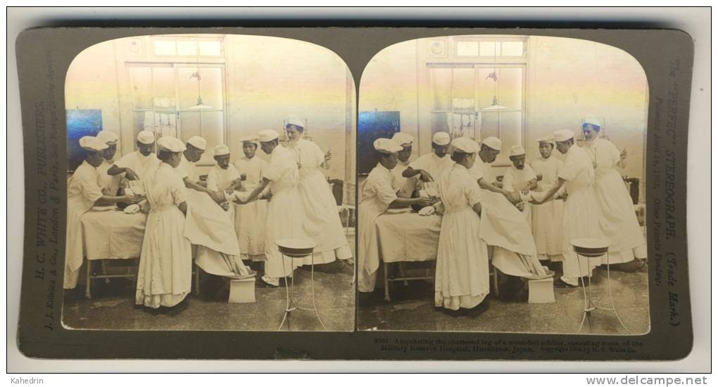 Japan (~1900´s) Amputating The Leg - Operation - Military Reserve Hospital (´Perfec´ Stereograph - H.C. White) - Stereoscoop