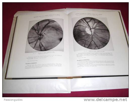 Ophtalmologie : ATLAS CLINIQUE D´OPHTALMOSCOPIE PHOTOGRAPHIQUE  SYNDROMES CLINIQUES FOND DE L´OEIL  39 H TILLE A COUADAU - 1901-1940