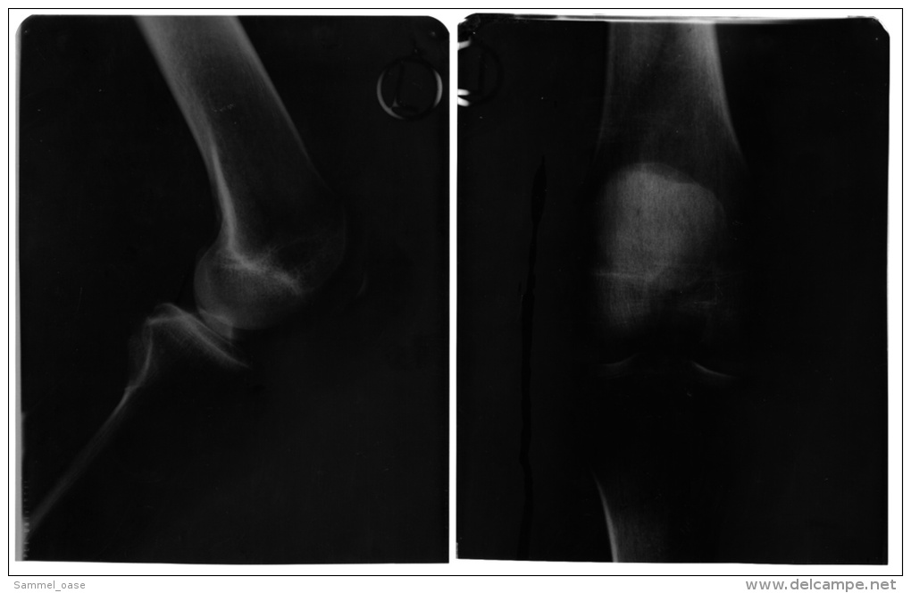 2 Original Kunststoff Röntgenbilder Von Einem Knie Eines Manns  -  Von 1982   (62) - Sonstige & Ohne Zuordnung