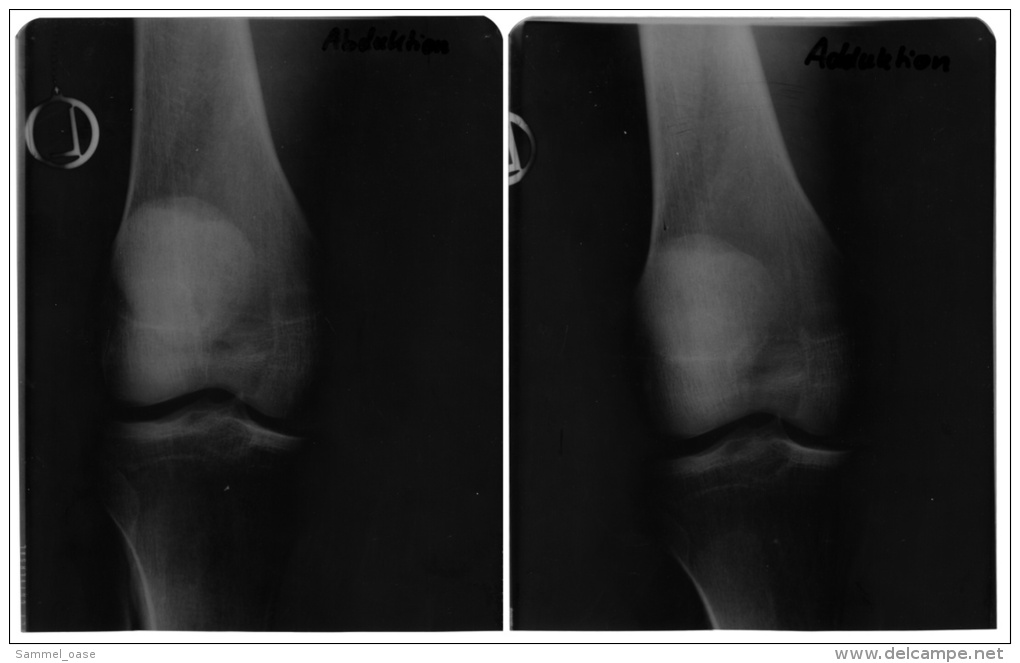 2 Original Kunststoff Röntgenbilder Von Einem Knie Eines Manns  -  Von 1982   (63) - Sonstige & Ohne Zuordnung