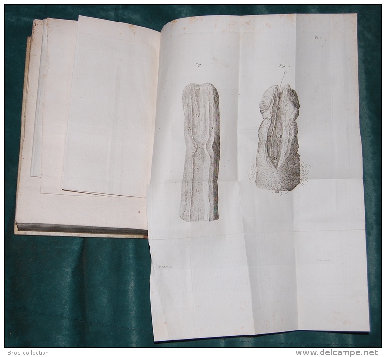 Traité Des Maladies Vénériennes, Jean Hunter, 1787, 7 Planches (chirurgien, Chirurgie, Médecine) - 1701-1800