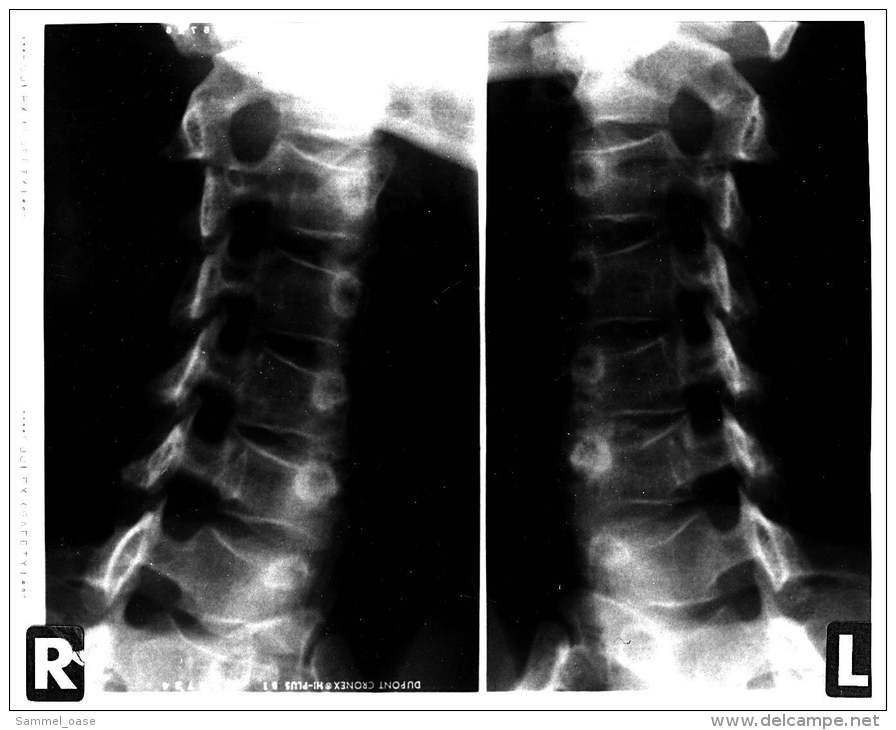 2 Original Kunststoff Röntgenbilder Von Einer Wirbelsäule Eines 41-jährigen Mann -  Von 1985   (106) - Sonstige & Ohne Zuordnung