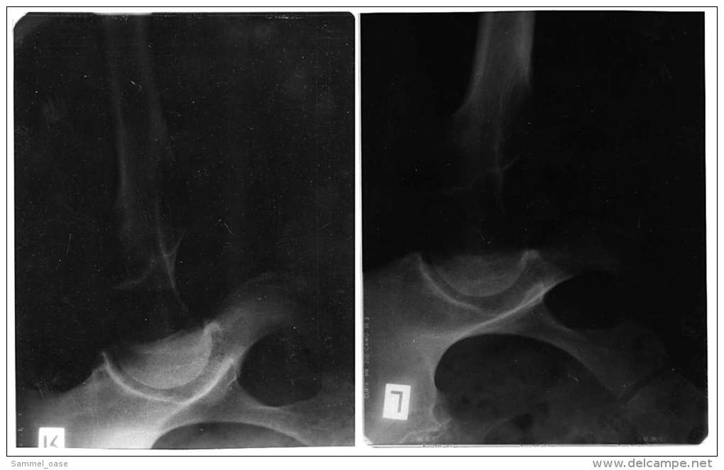 2 Original Kunststoff Röntgenbilder Von Einem Becken Einer 72-jährigen Frau -  Von 1984   (120) - Sonstige & Ohne Zuordnung