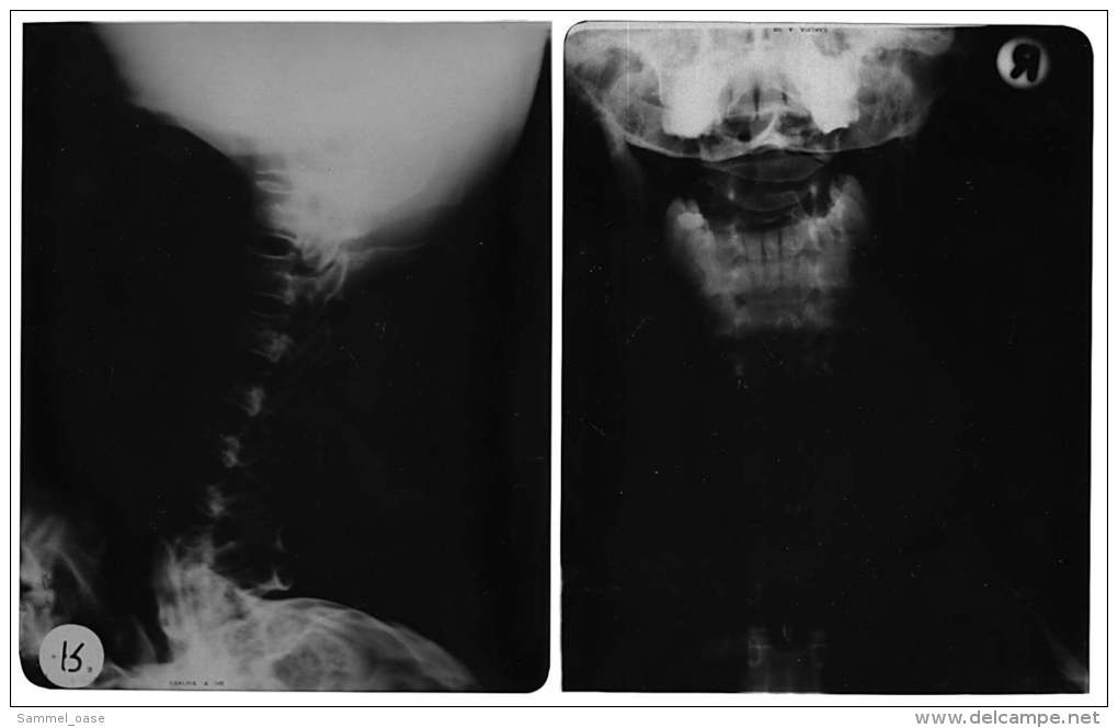 2 Original Kunststoff Röntgenbilder Von Einem Halswirbel Einer 34-jährigen Frau -  Von 1979   (104) - Sonstige & Ohne Zuordnung