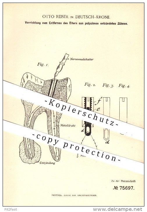 Original Patent - Otto Reiser In Deutsch - Krone , 1893 , Entfernen Von Eiter Aus Zähnen , Zahn , Zähne , Zahnarzt !!! - Historische Dokumente