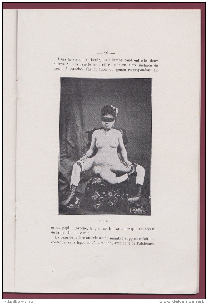 290716 - Revue Médecine BORDEAUX 1912 Dr BAUDRIMONT A - PYGOMELIE CHEZ L'HOMME - Malformation Anomalie Phenomene Monstre - 1901-1940