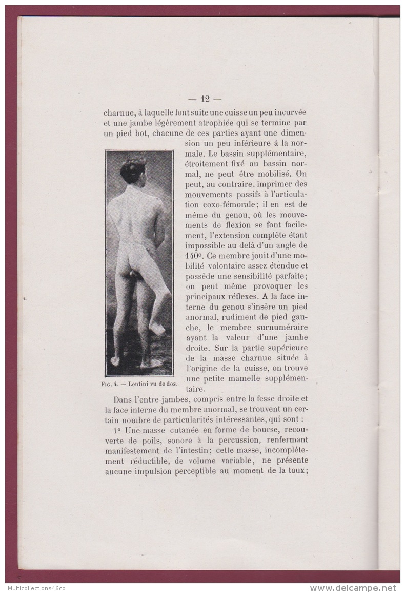 290716 - Revue Médecine BORDEAUX 1912 Dr BAUDRIMONT A - PYGOMELIE CHEZ L'HOMME - Malformation Anomalie Phenomene Monstre - 1901-1940