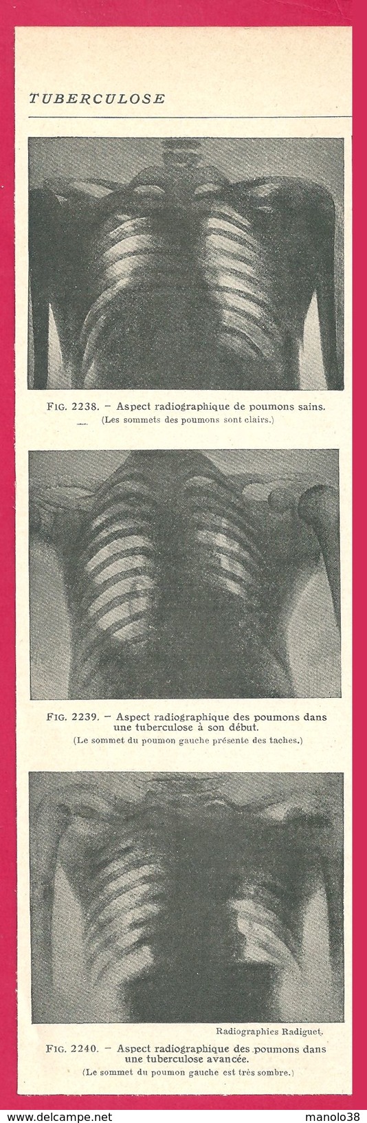 Tuberculose Aspect Radiographique  Larousse Médical 1929 - Non Classés