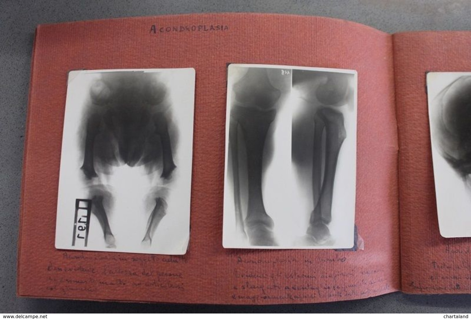 Album Fotografico Didattico -  21 Radiografie Malattie Ossa - Medicina Anni '50 - Altri & Non Classificati