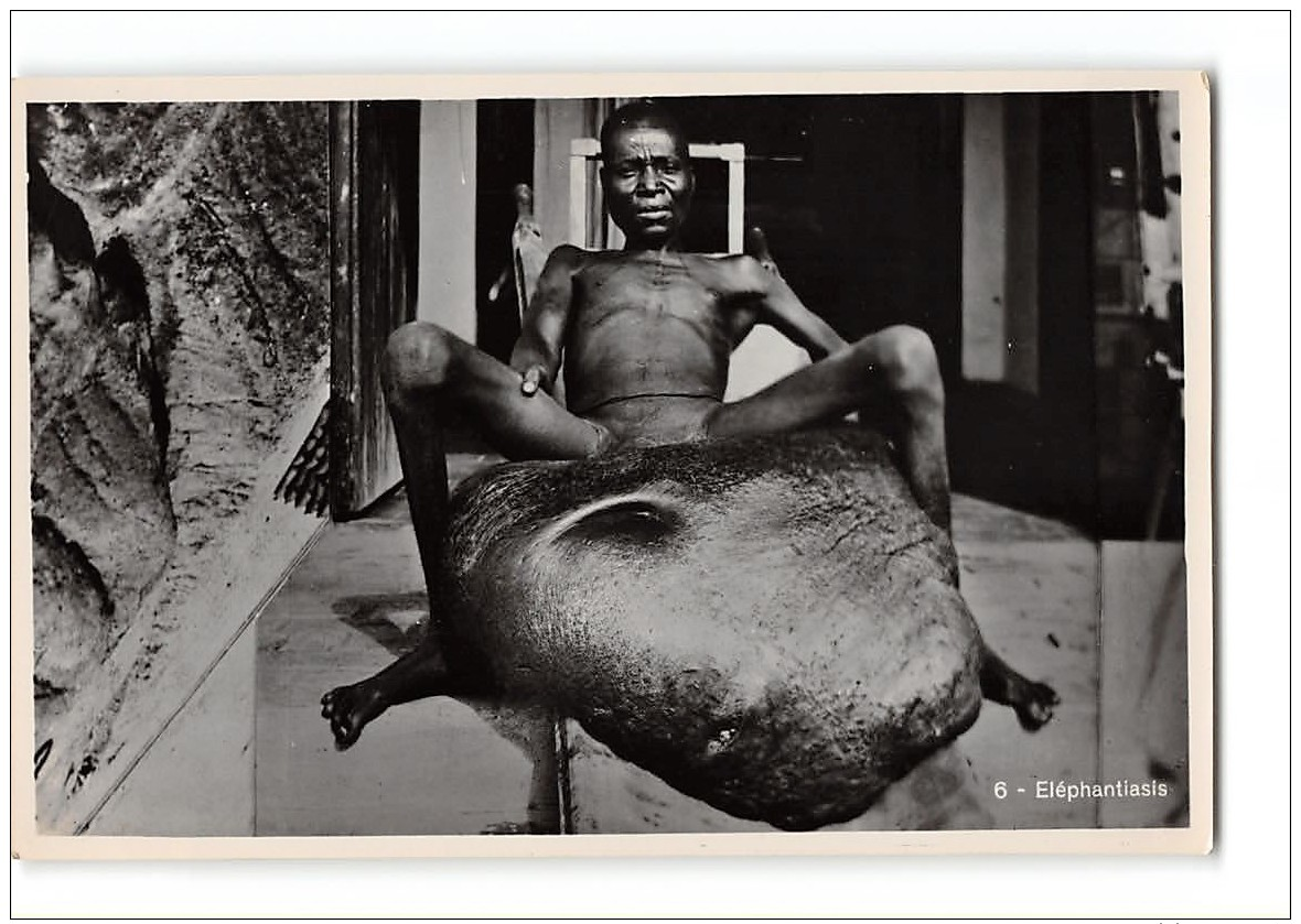 Photo Format Cpa Zagourski L'afrique Qui Disparait Elephantiasis N*6 - Autres & Non Classés