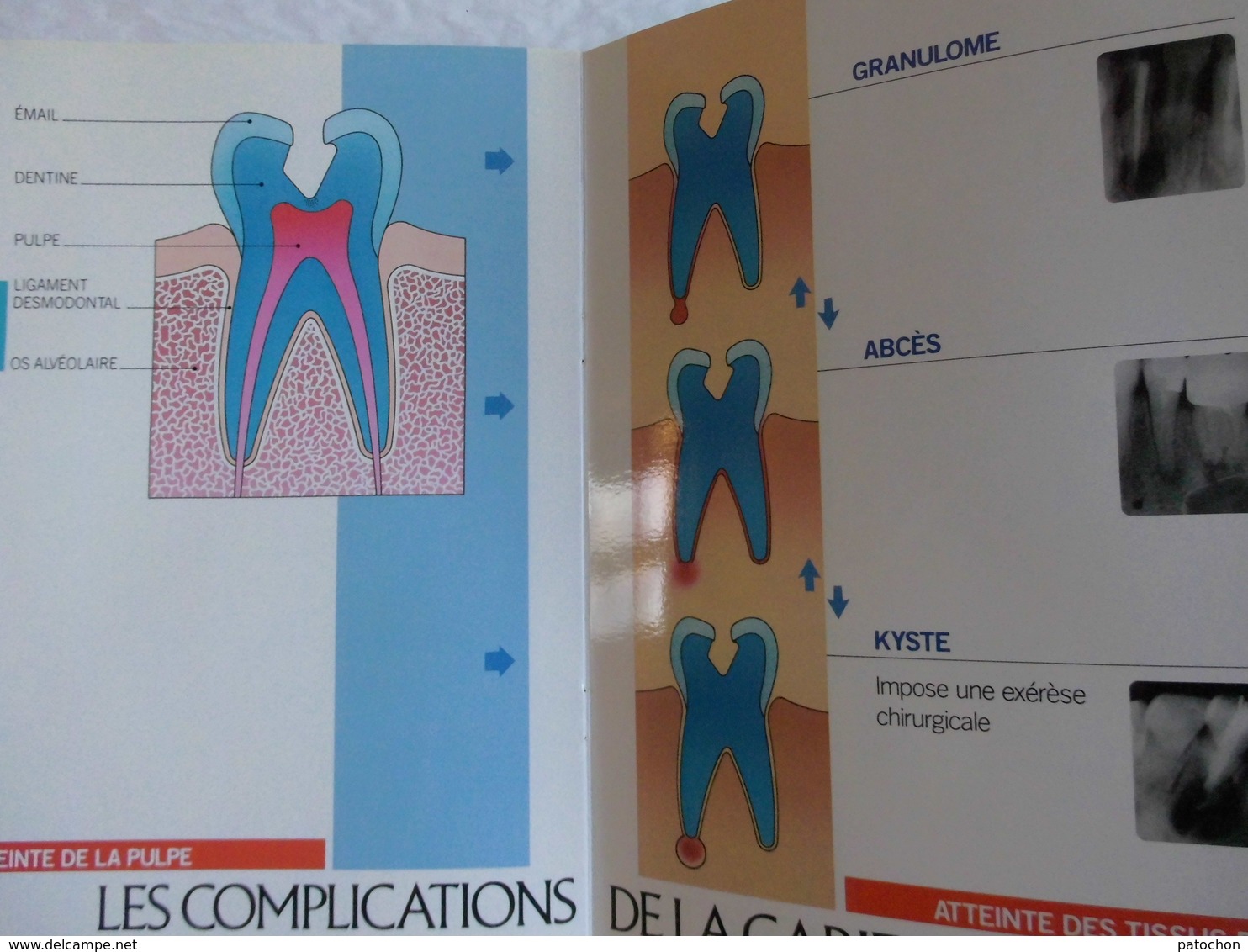 2 plaquettes Dentiste explicative Caries & Complications Couronnes & Bridges...!