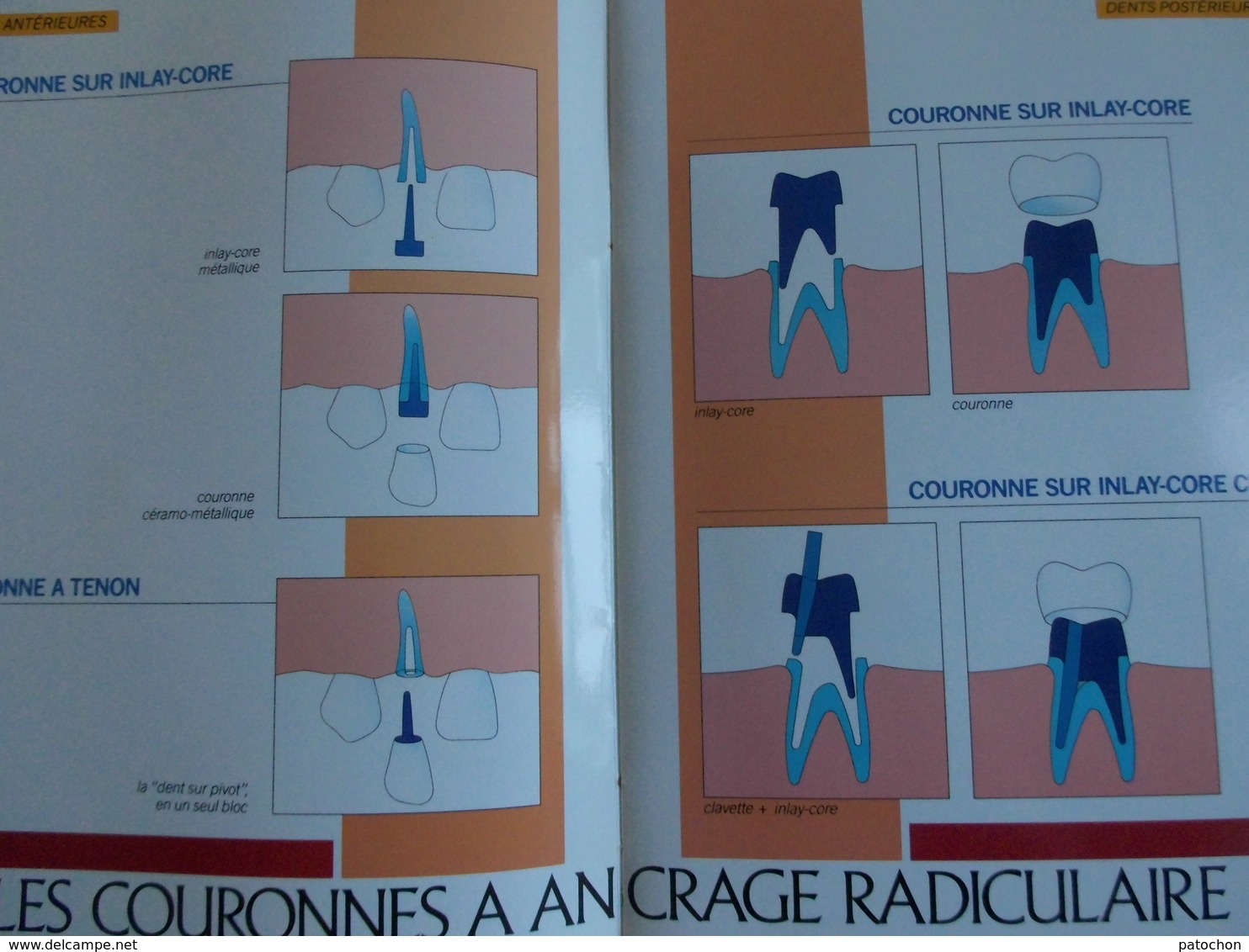 2 plaquettes Dentiste explicative Caries & Complications Couronnes & Bridges...!