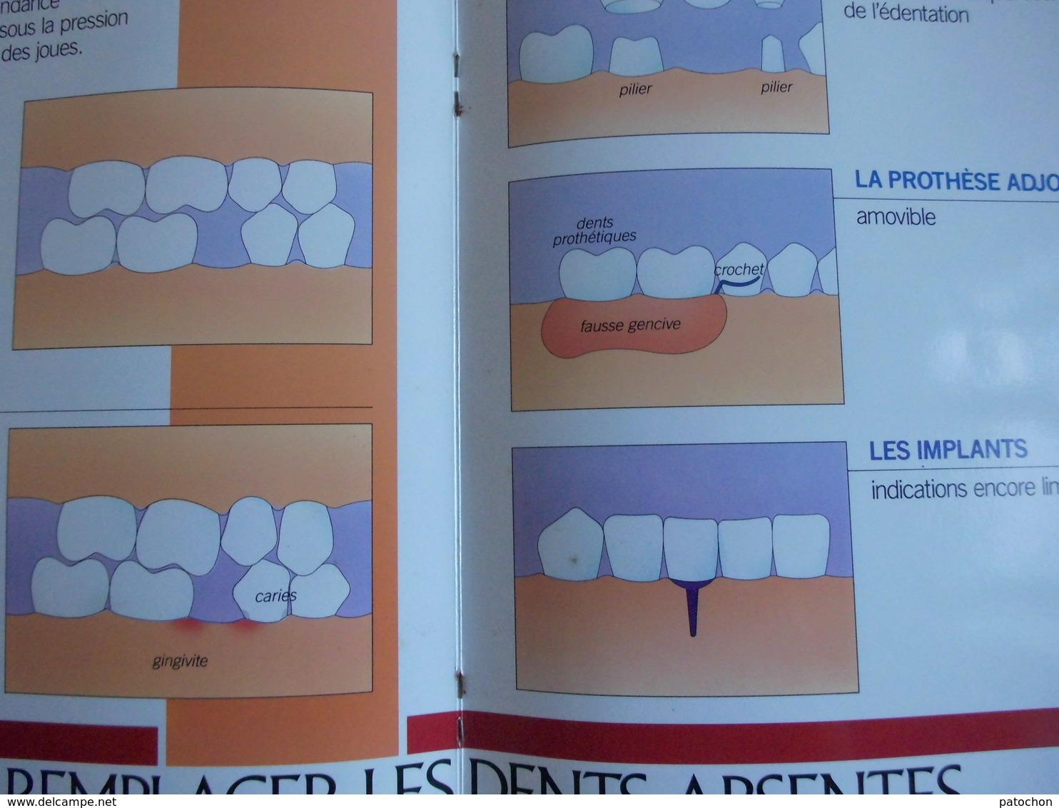 2 plaquettes Dentiste explicative Caries & Complications Couronnes & Bridges...!