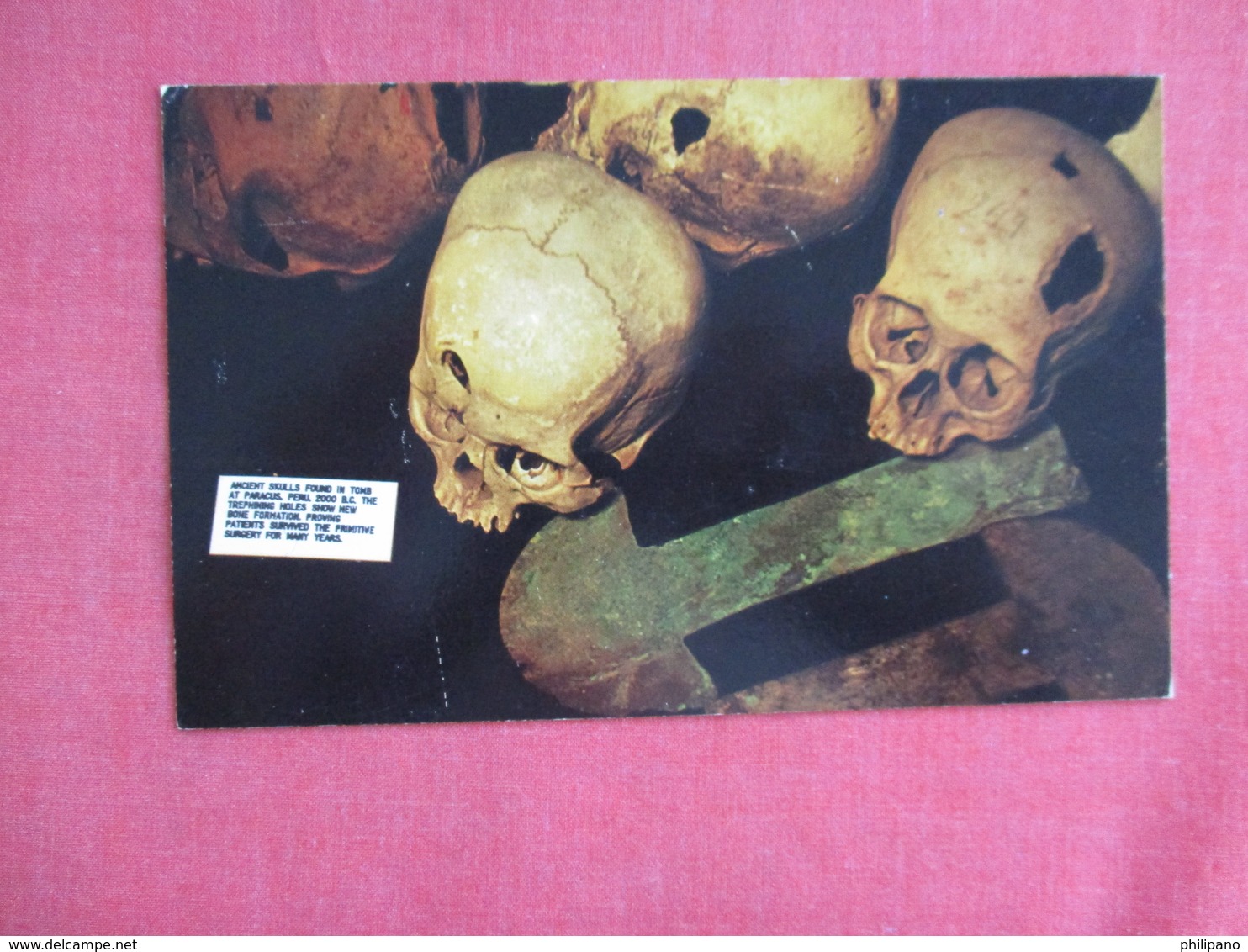 Trephined Peruvian Skulls    Ref 3123 - Peru