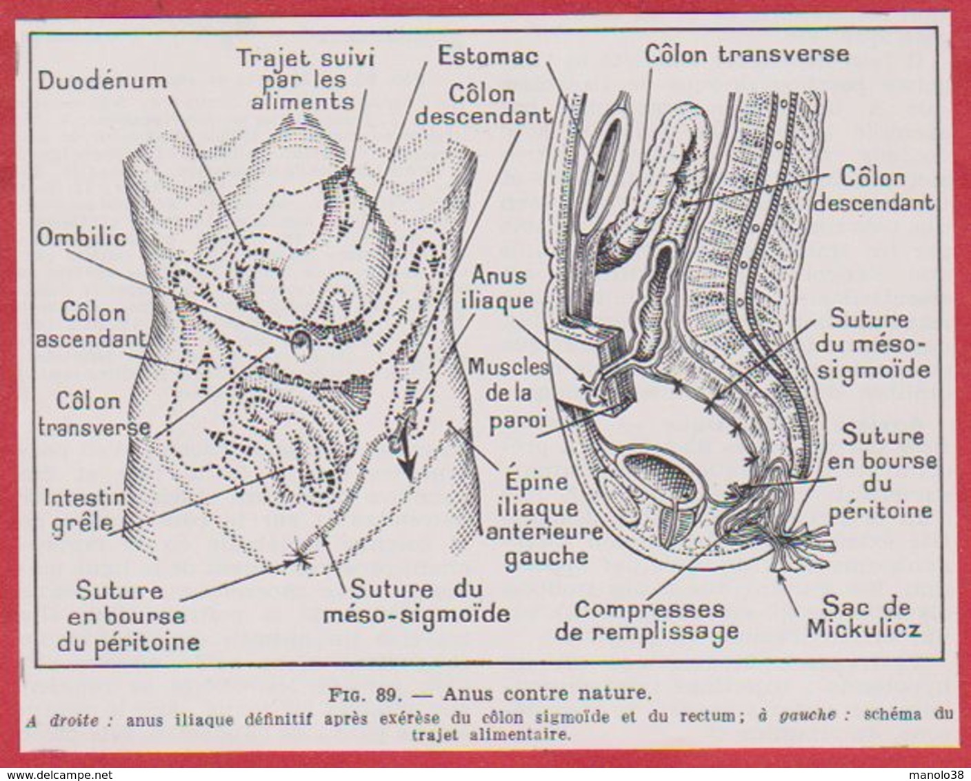 Anus Contre Nature. Larousse Médical De 1974. - Autres & Non Classés