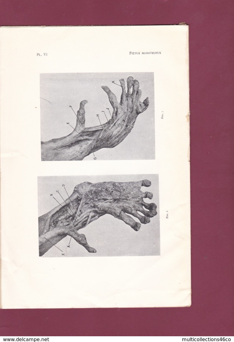 260519A - Livre J FILIPE FERREIRA Porto - 1937 MEDECINE Dissection Foetus Monstrueux Syphilis Anatomie Malformation - Sciences