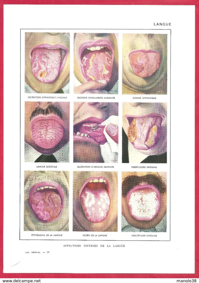 Langue. Affections Diverses De La Langue. Larousse Médical 1974. - Non Classés