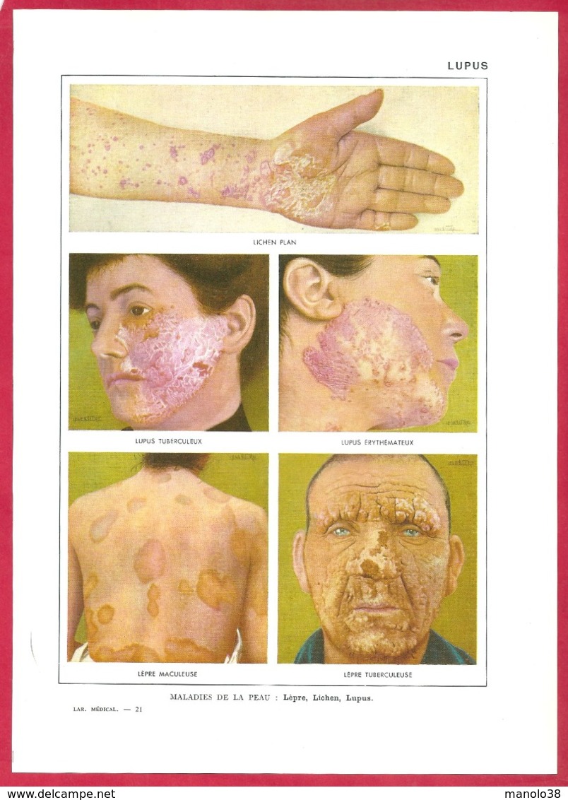 Lupus. Maladies De La Peau: Lèpre, Lichen, Lupus. Larousse Médical 1974. - Non Classés