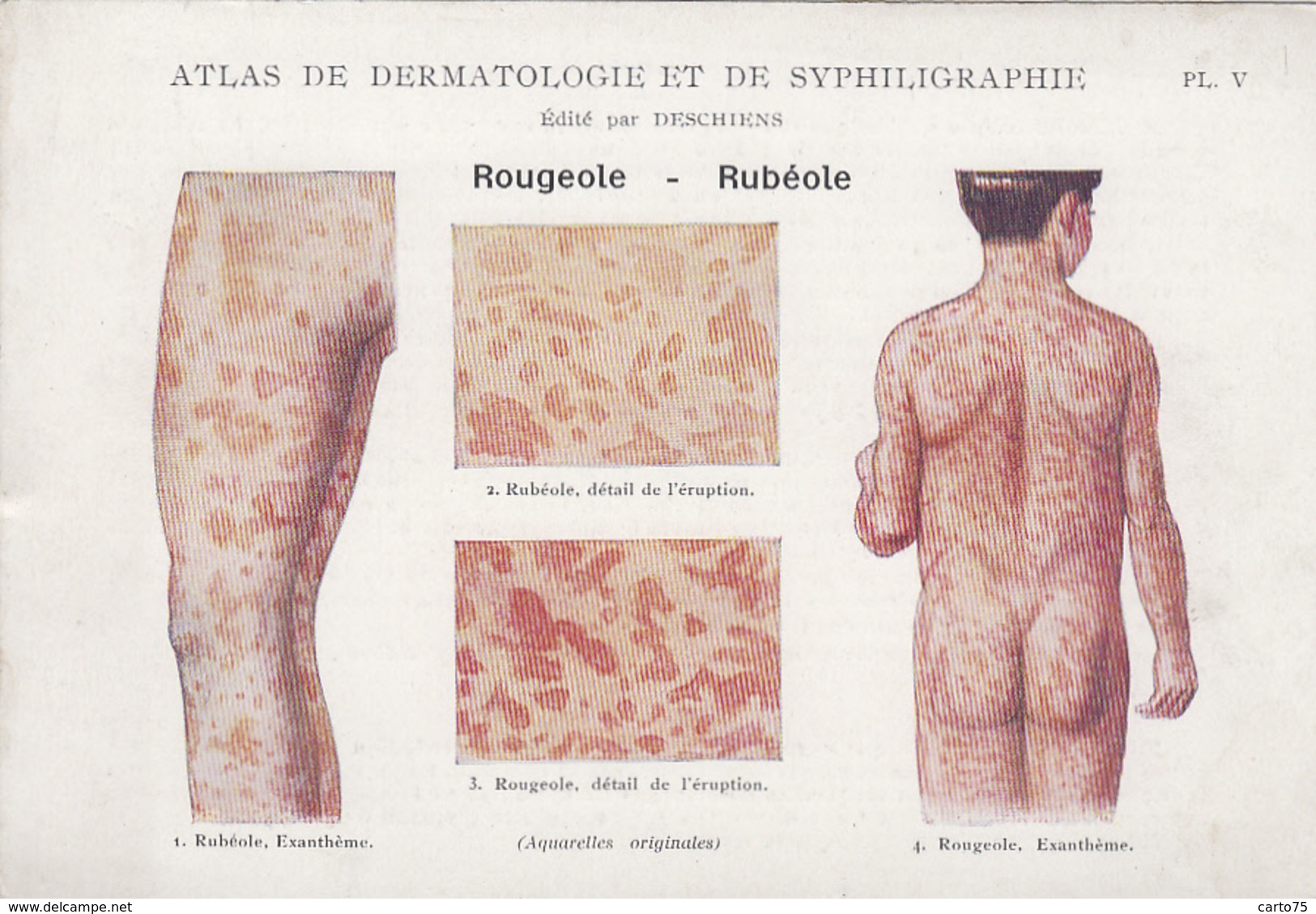 Santé - Fiche Dermatologie Et Syphiligraphie - Edité Par Deschiens - Rougeole Et Rubéole - Santé