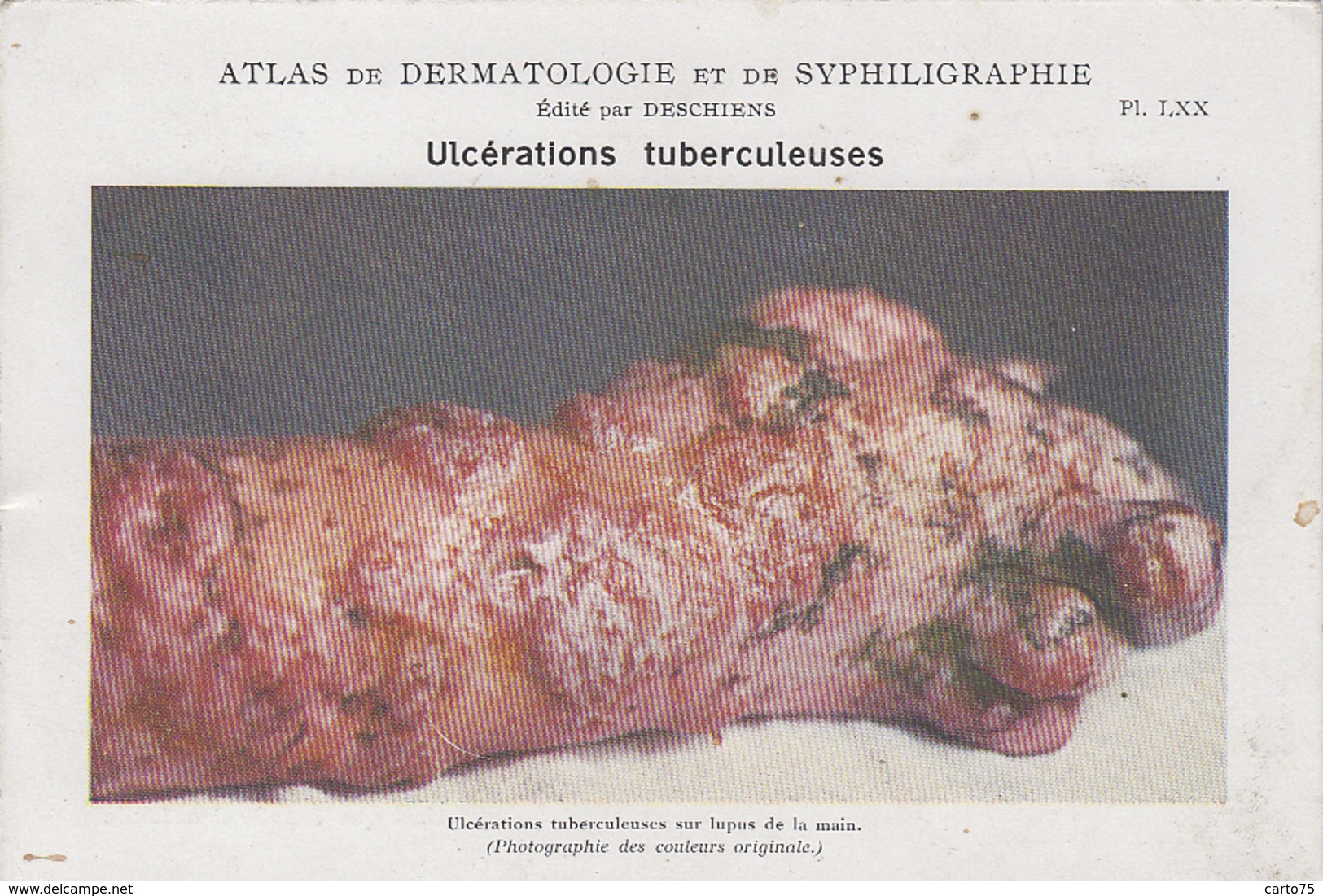 Santé - Fiche Dermatologie Et Syphiligraphie - Edité Par Deschiens - Ulcérations Tuberculeuses - Santé