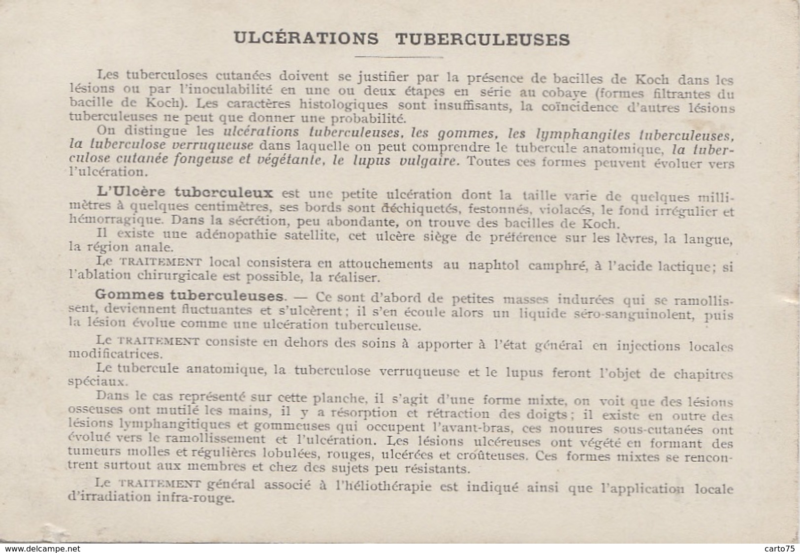 Santé - Fiche Dermatologie Et Syphiligraphie - Edité Par Deschiens - Ulcérations Tuberculeuses - Santé