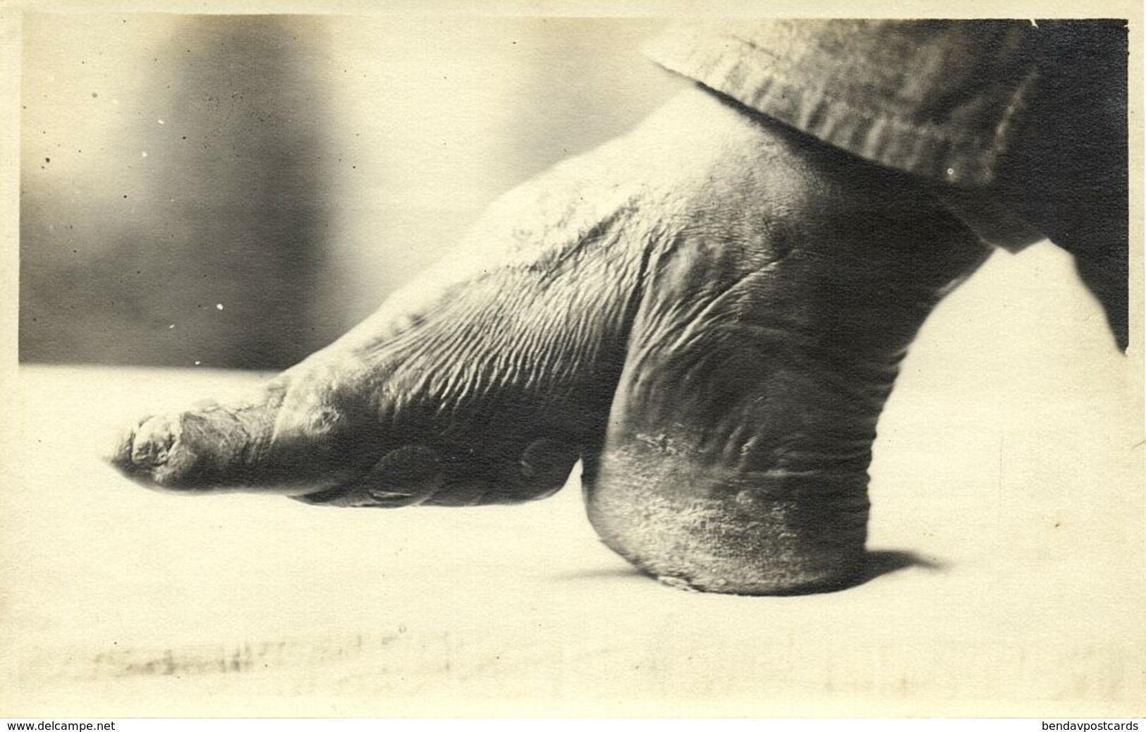 China, Result Of Bounding Feet, Foot Binding (1910s) Real Photo - China