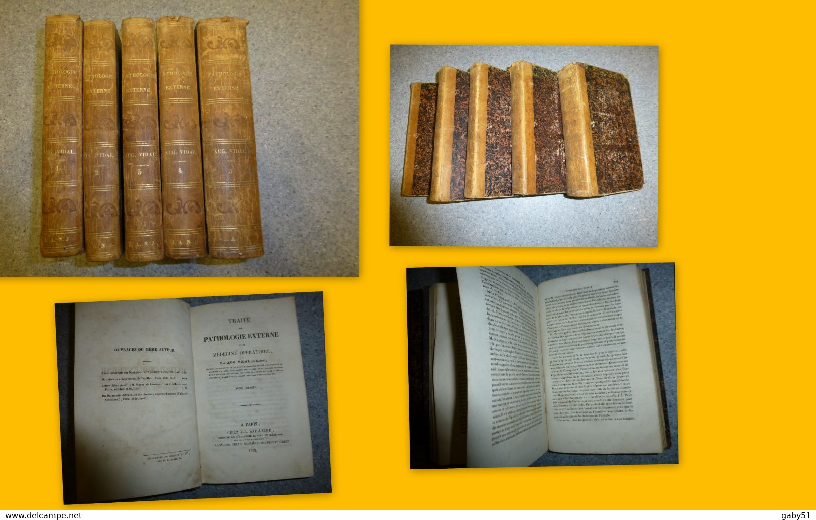 VIDAL, Traité De Pathologie Externe, 5 Tomes, Baillière, 1841 Reliures Dos Cuir TB  ; SOL03 - 1801-1900