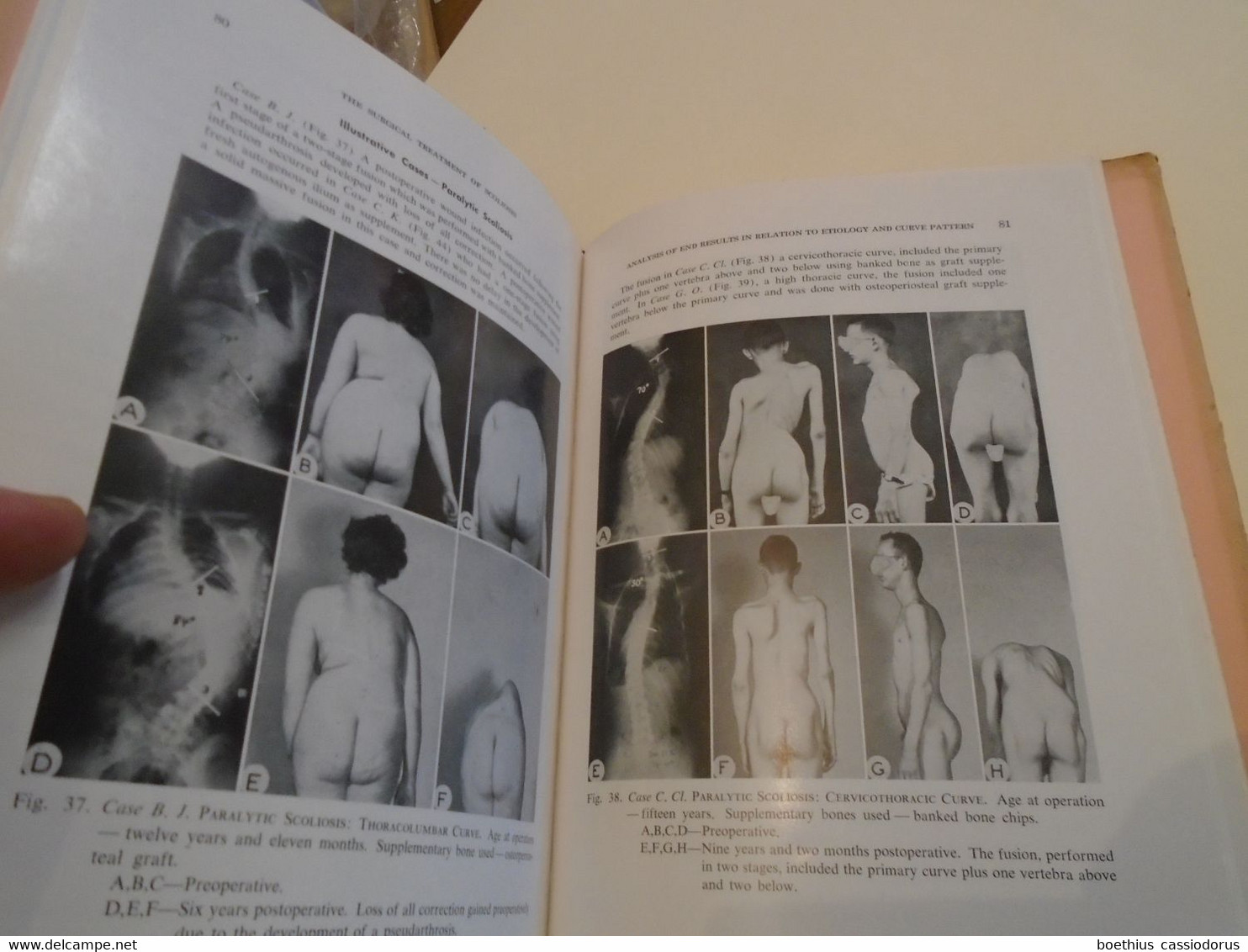 SURGERY MEDICINE : SURGICAL TREATMENT OF SCOLIOSIS L A GOLDSTEIN,  APPENDIX ANESTHESIA IN SCOLIOSIS D V THOMAS (1959 ?) - Chirurgia