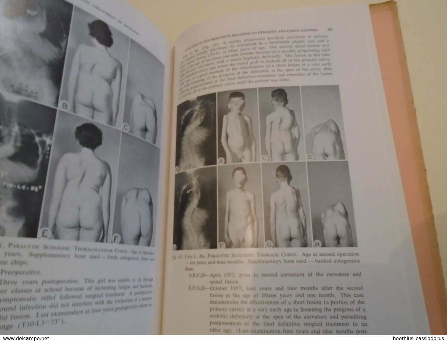 SURGERY MEDICINE : SURGICAL TREATMENT OF SCOLIOSIS L A GOLDSTEIN,  APPENDIX ANESTHESIA IN SCOLIOSIS D V THOMAS (1959 ?)