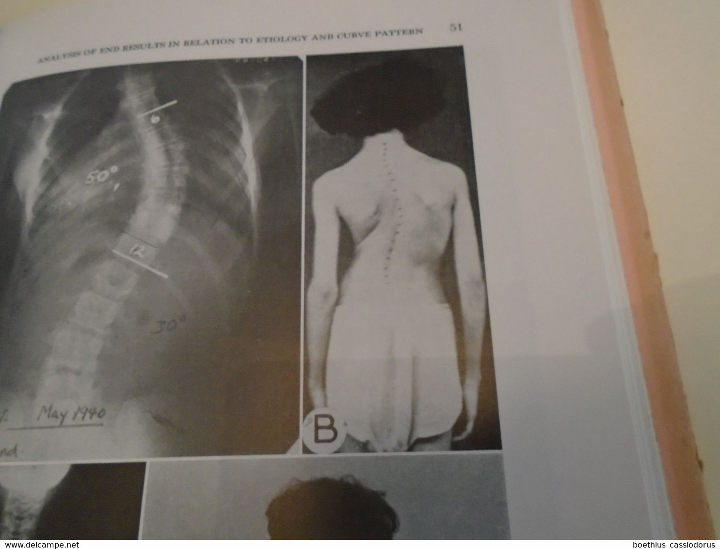 SURGERY MEDICINE : SURGICAL TREATMENT OF SCOLIOSIS L A GOLDSTEIN,  APPENDIX ANESTHESIA IN SCOLIOSIS D V THOMAS (1959 ?)