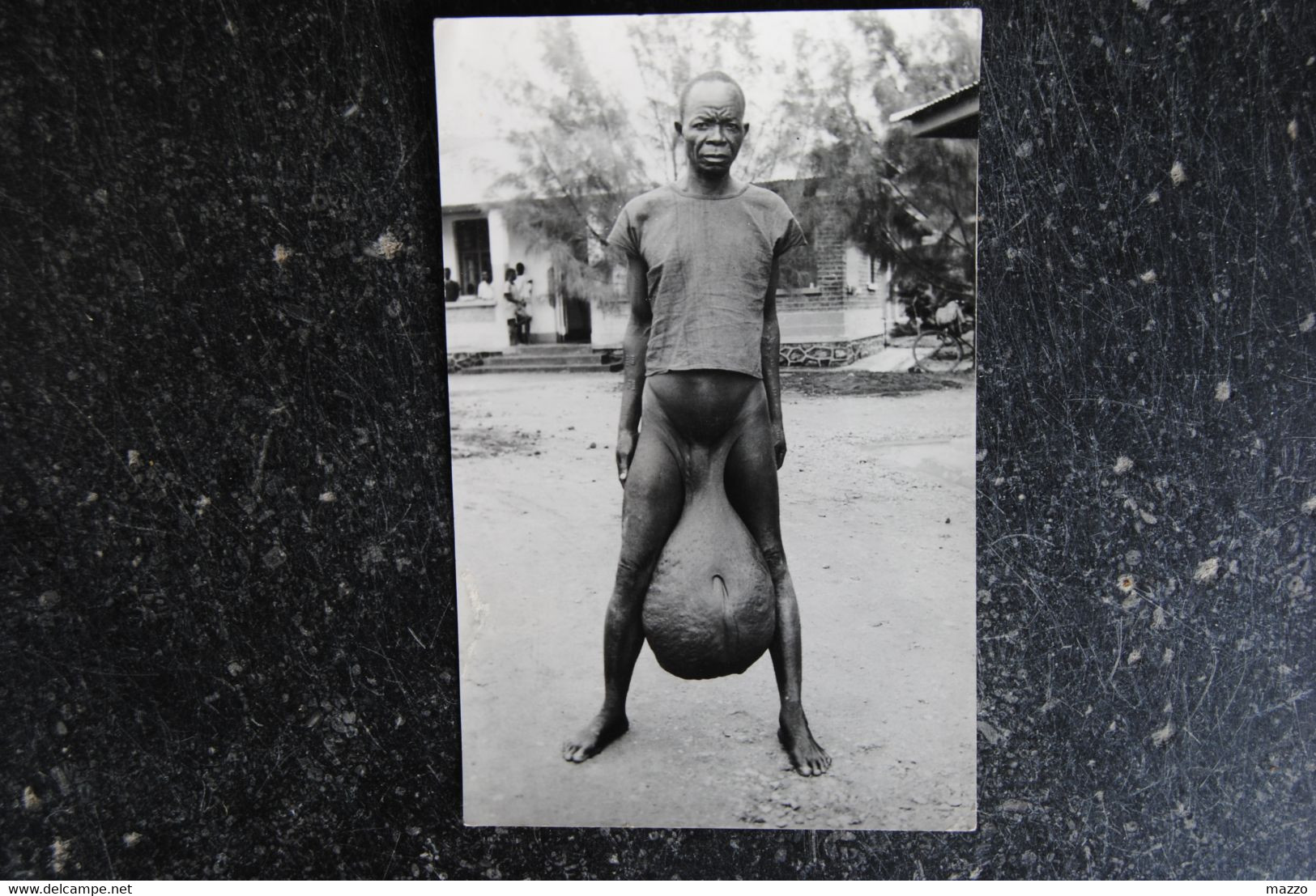 5483/ Afrique-Africain Atteint D'Elephantiasis Scrotal - Other & Unclassified