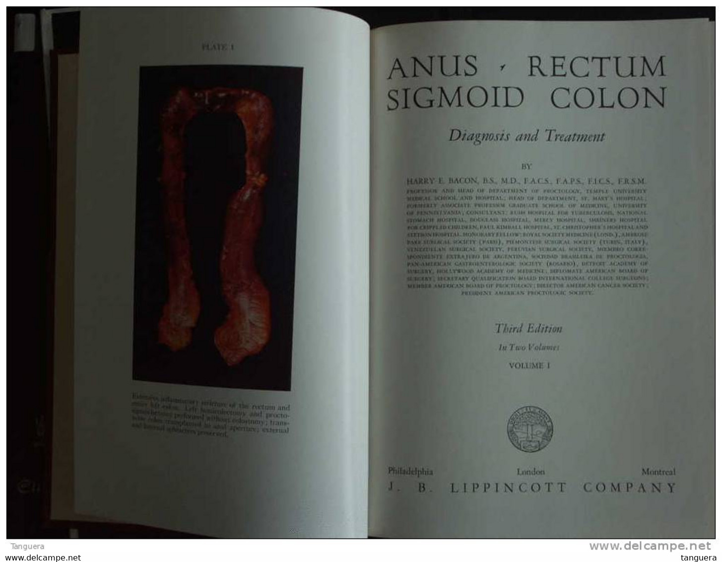 ANUS - RECTUM - SIGMOID COLON Diagnosis And Treatment By Harry E. Bacon -Third Edition In Two Volumes - Lippincott - Chirurgia