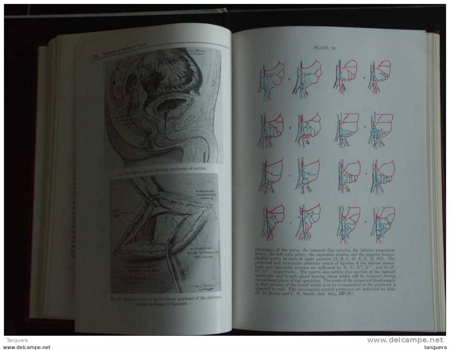 ANUS - RECTUM - SIGMOID COLON Diagnosis And Treatment By Harry E. Bacon -Third Edition In Two Volumes - Lippincott - Surgery