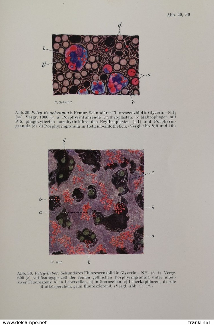 Untersuchungen über Porphyrie mit besonderer Berücksichtigung der Porphyria Congenita.