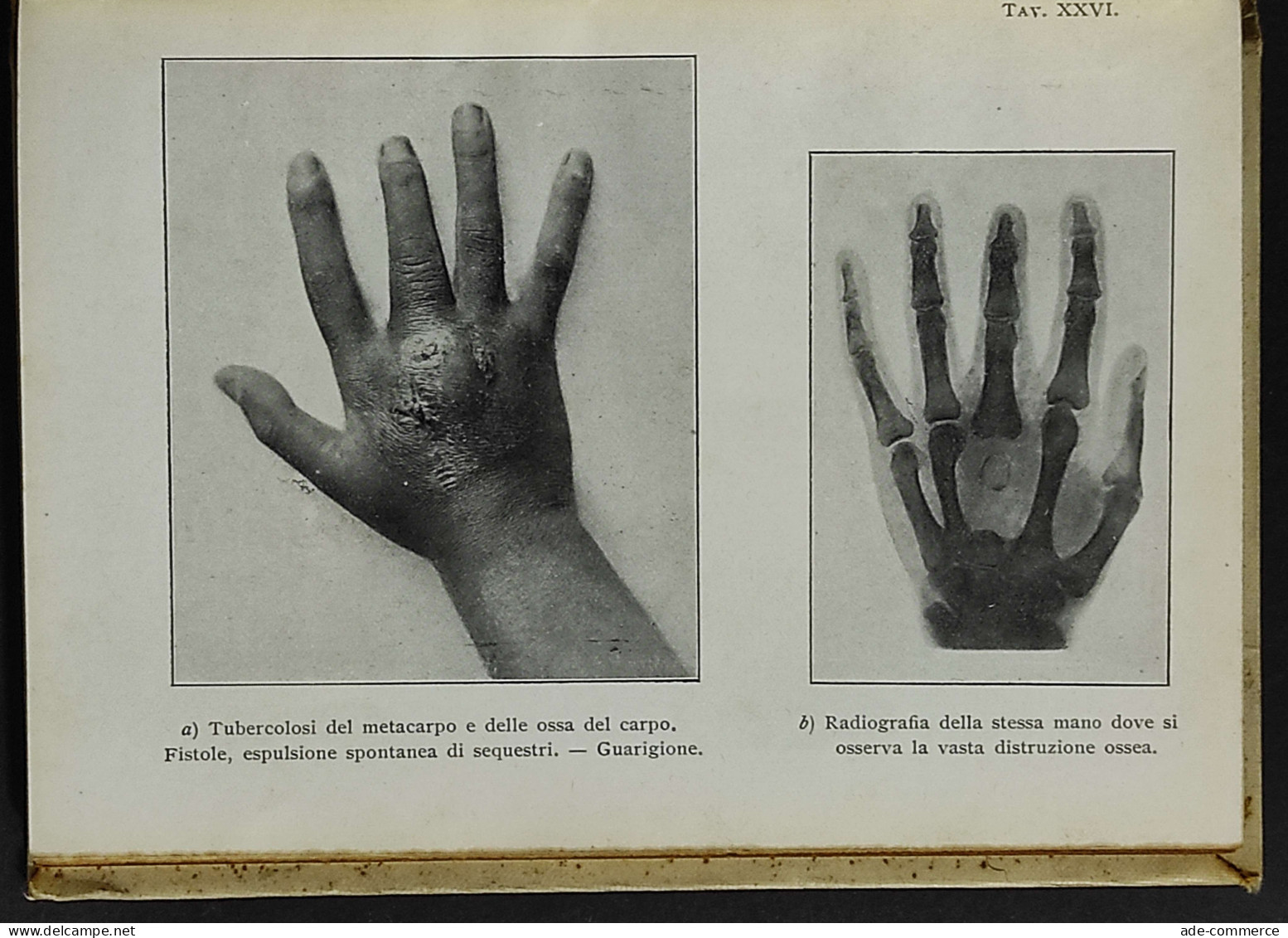 L'Elioterapia In Alta Montagna - B.-Curti - Ed. Hoepli - 1914 - Medicina, Psicología