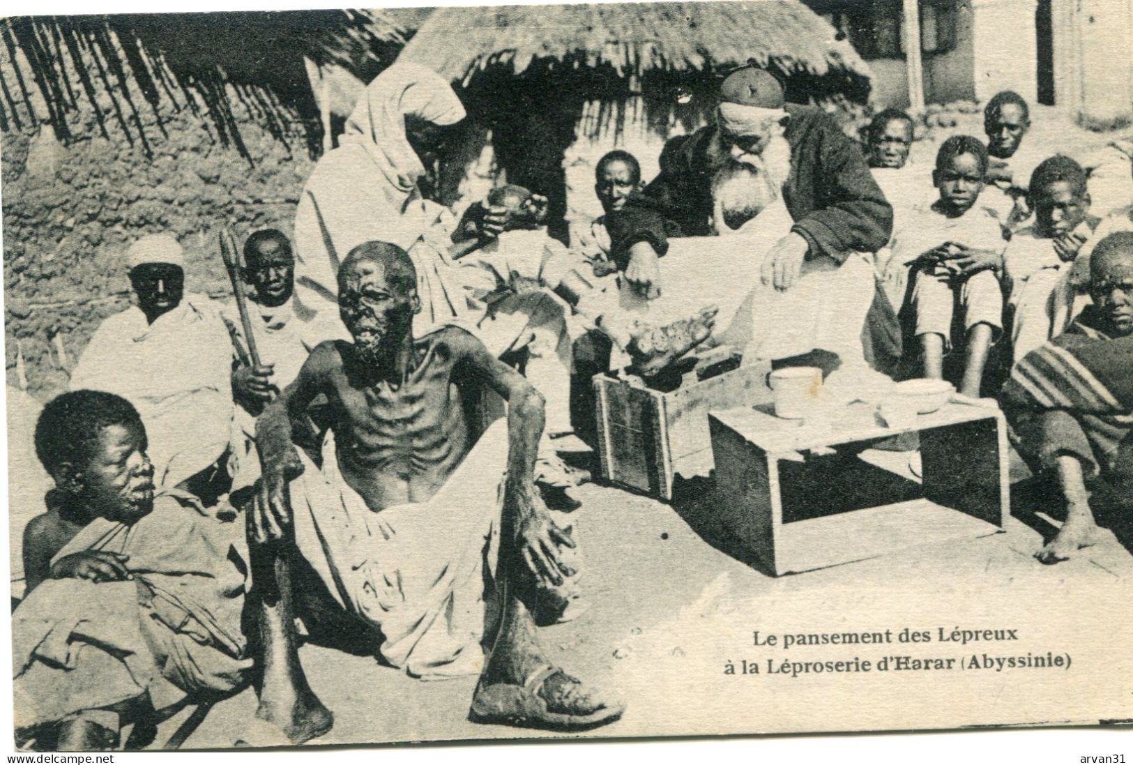LE PANSEMENT Des LEPREUX à La LEPROSERIE D' HARAR - - Etiopia