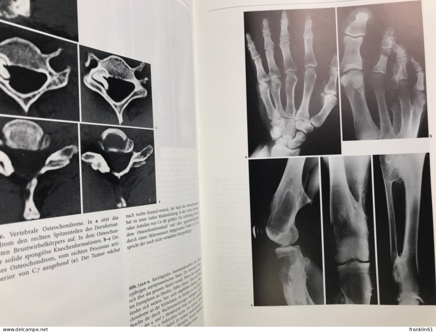 Knochentumoren : Klinik, Radiologie, Pathologie. - Gezondheid & Medicijnen