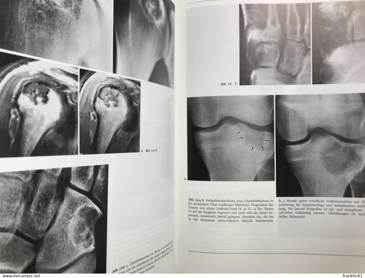 Knochentumoren : Klinik, Radiologie, Pathologie. - Salud & Medicina