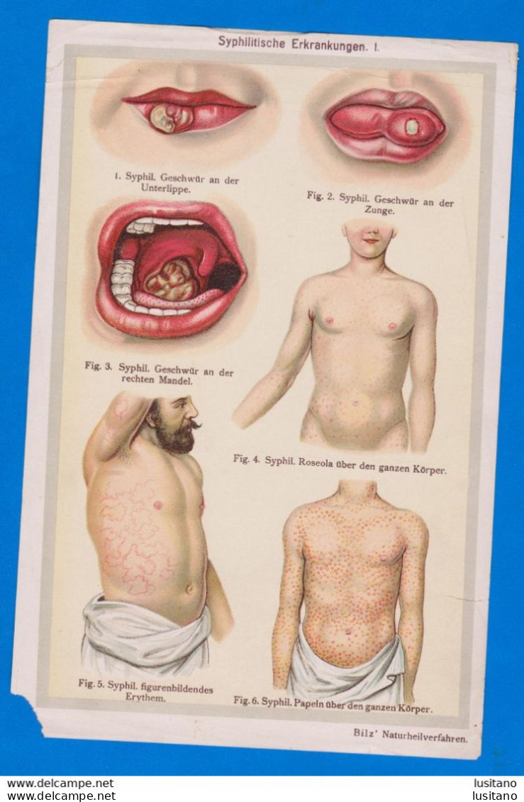 Syphilis, Syphilitic Diseases, Friedrich Eduard Bilz, Naturopathic Medicine , Germany - Publicités