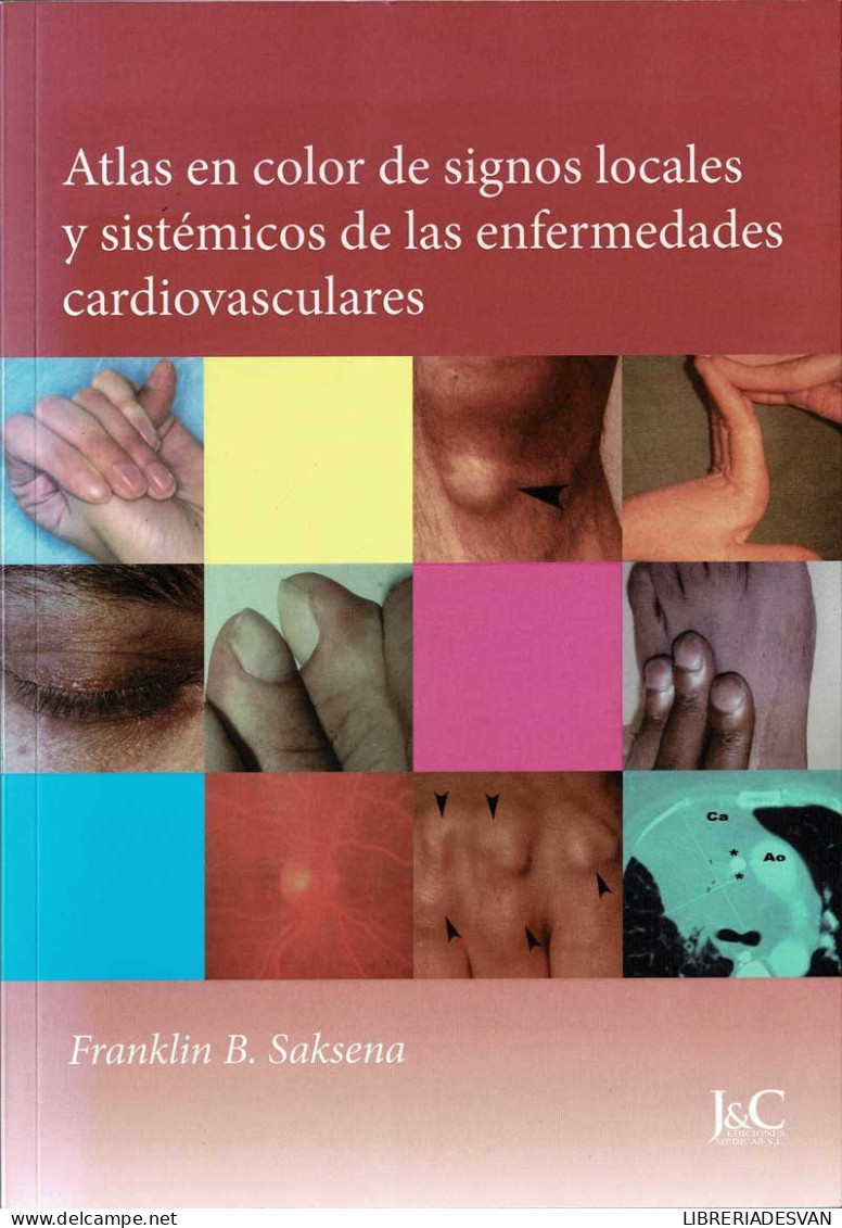 Atlas En Color De Signos Locales Y Sistémicos De Las Enfermedades Cardiovasculares - Franklin B. Saksena - Santé Et Beauté