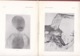 260519A - Livre J FILIPE FERREIRA Porto - 1937 MEDECINE Dissection Foetus Monstrueux Syphilis Anatomie Malformation - Sciences