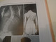 Delcampe - SURGERY MEDICINE : SURGICAL TREATMENT OF SCOLIOSIS L A GOLDSTEIN,  APPENDIX ANESTHESIA IN SCOLIOSIS D V THOMAS (1959 ?) - Chirurgia