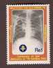Pakistan 1982, 100 Years Of Discovery Of T.B. Bacillus, Chest X-ray 1v MNH - Pakistan