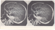 IMPRIME STEREOSCOPIQUE - RADIOGRAPHIE DE LA VASCULARISATION CEREBRALE - Stereoscope Cards