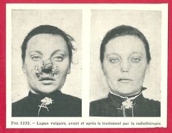 Lupus Vulgaire, Avant Et Après Le Traitement Par La Radiothérapie, Larousse Médical De 1934 - Andere