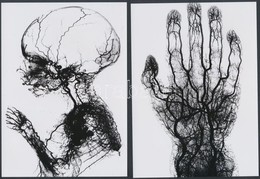 Cca 1910 Orvosi Felvételek, érfestéssel Készített Röntgen Fotók, 4 Db Korabeli Vintage Képről Készített Mai Másolatok, 1 - Sonstige & Ohne Zuordnung