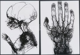 Cca 1910 Orvosi Felvételek, érfestéssel Készített Röntgen Fotók, 4 Db Korabeli Vintage Képről Készített Mai Másolatok, 1 - Autres & Non Classés