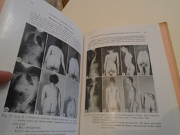 SURGERY MEDICINE : SURGICAL TREATMENT OF SCOLIOSIS L A GOLDSTEIN,  APPENDIX ANESTHESIA IN SCOLIOSIS D V THOMAS (1959 ?) - Chirurgia